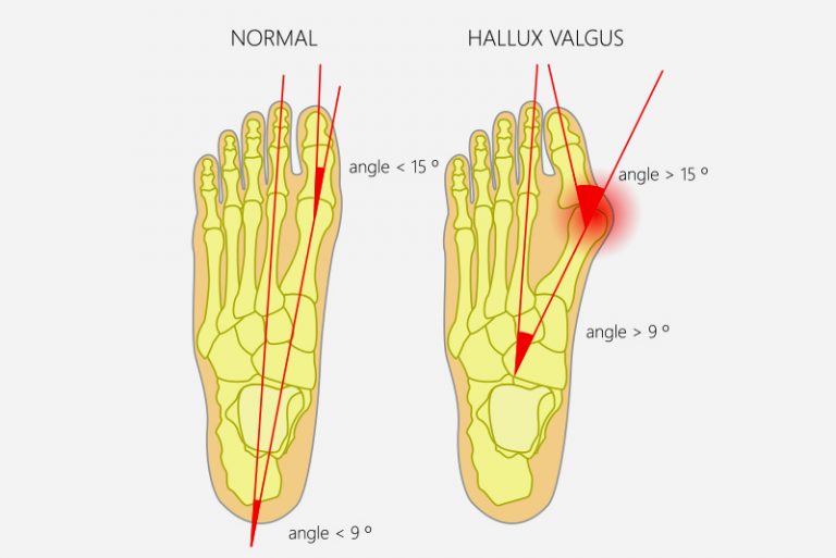 Toe Problems Sanders Podiatry Adelaide, Stirling, Mount Barker