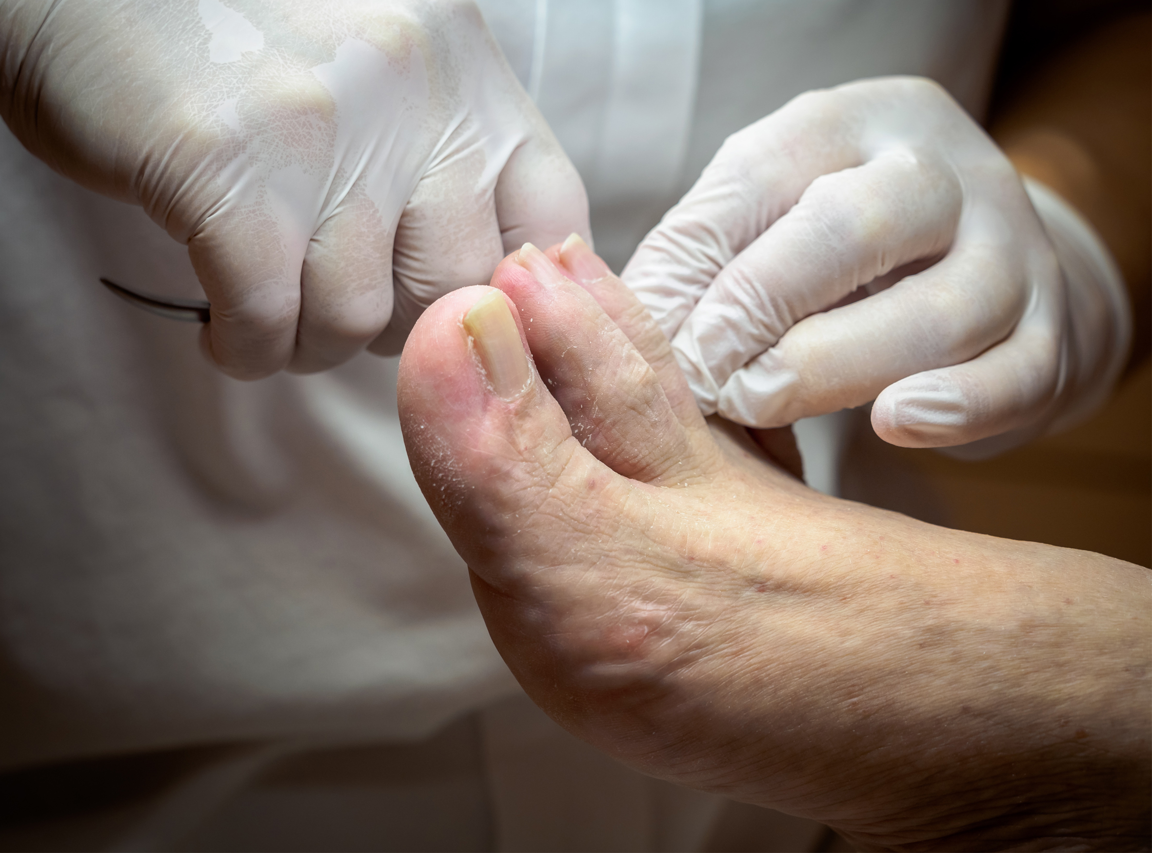 Diabetes foot care and guidelines for healthy feet | Sanders Podiatry