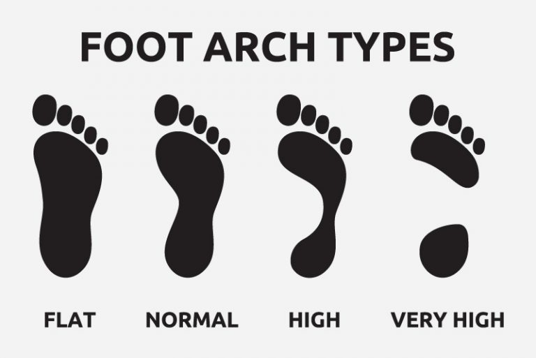 High Arches: Causes, Symptoms and Treatment | Sanders Podiatry
