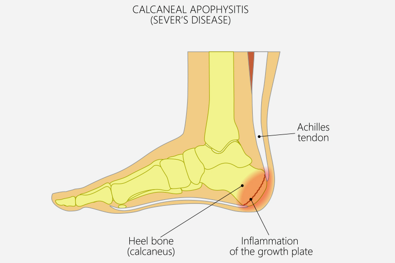 Children’s Feet Sanders Podiatry Adelaide, Stirling, Mount Barker