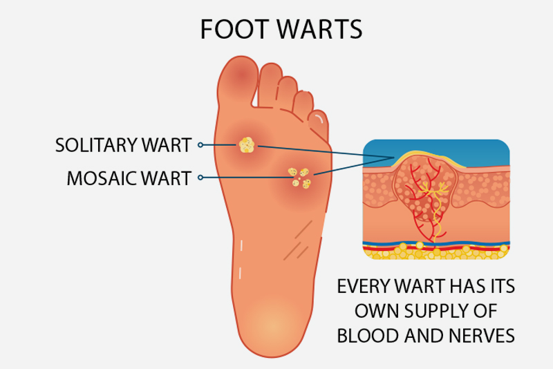 Wart on Foot: Types, Causes, and How to Get Rid of It