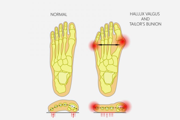 Toe Problems | Sanders Podiatry – Adelaide, Stirling, Mount Barker