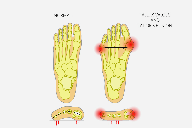 Toe Problems | Sanders Podiatry – Adelaide, Stirling, Mount Barker