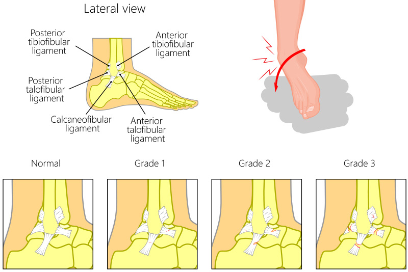 Sports Injuries | Sanders Podiatry – Adelaide, Stirling, Mount Barker