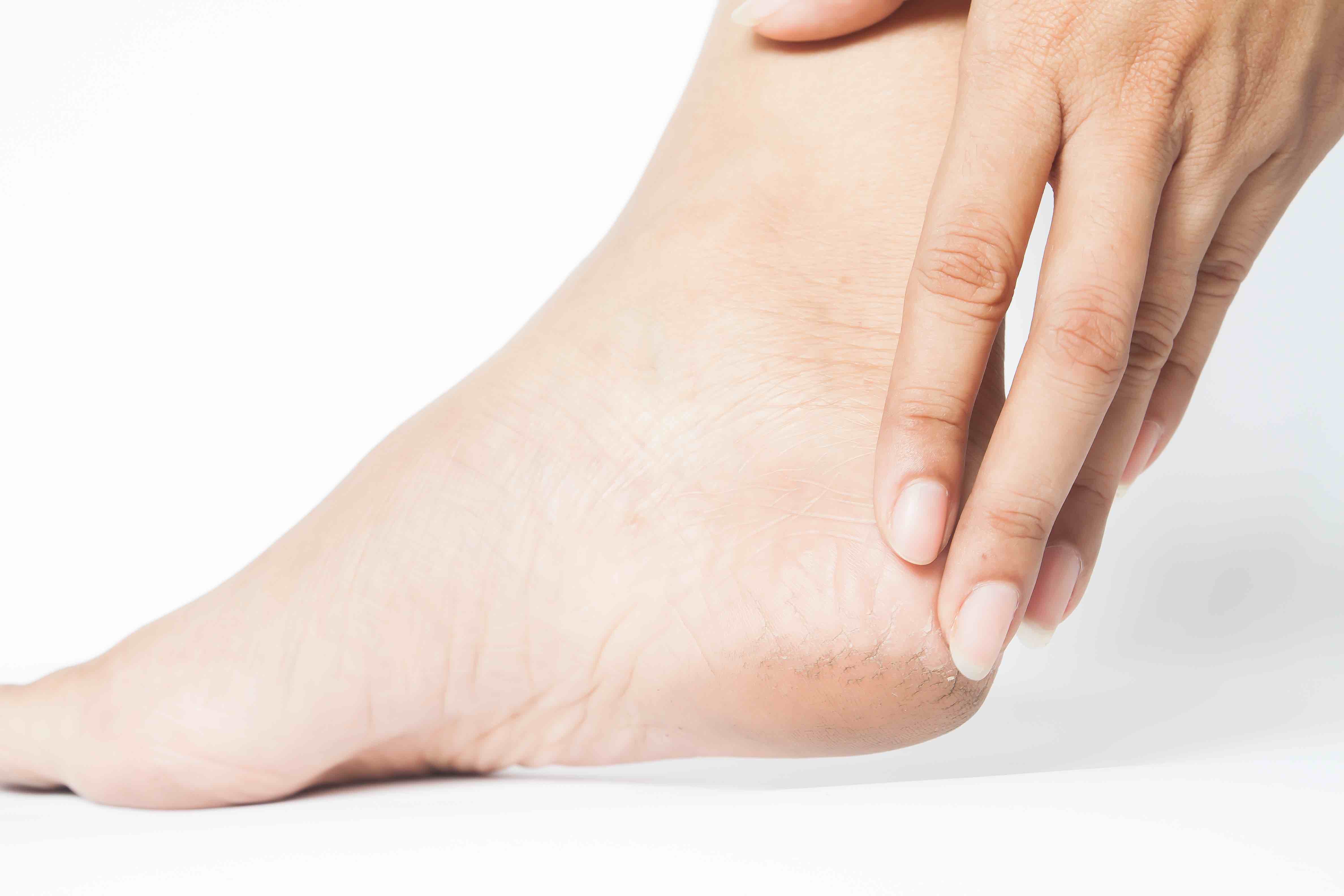 Possible Causes of Cracked Heels: Apple Podiatry Group: Podiatrists