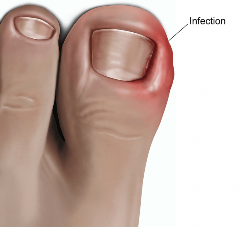 Ingrown toenails Causes, Symptoms and Treatment