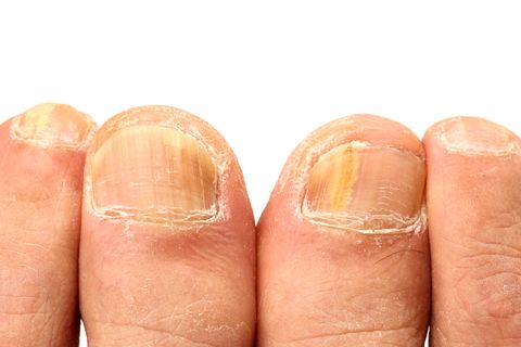 Thick and Gnarly Toenails: Causes, Symptoms and Treatment | Sanders  Podiatry Adelaide